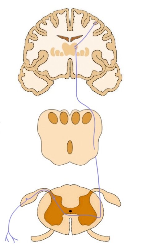 Pathway of the lateral spinothalamic tract.